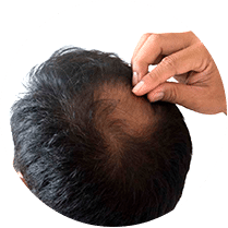 Alopecia Androgenética
