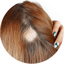 Alopecia areata