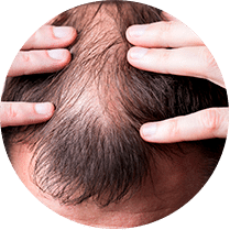 Alopecia cicatricial e não cicatricial