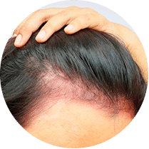 Alopecia Fibrosante Frontal