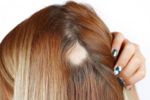 Quais são os sintomas da alopecia areata?